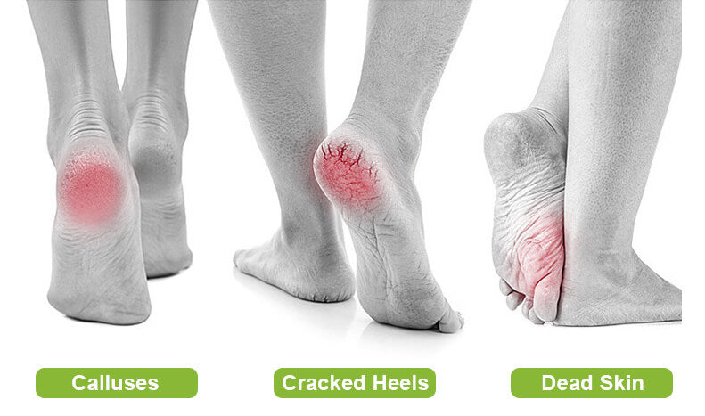 SoftFeet™ Electric Foot File