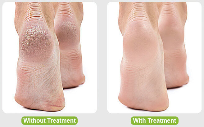 SoftFeet™ Electric Foot File